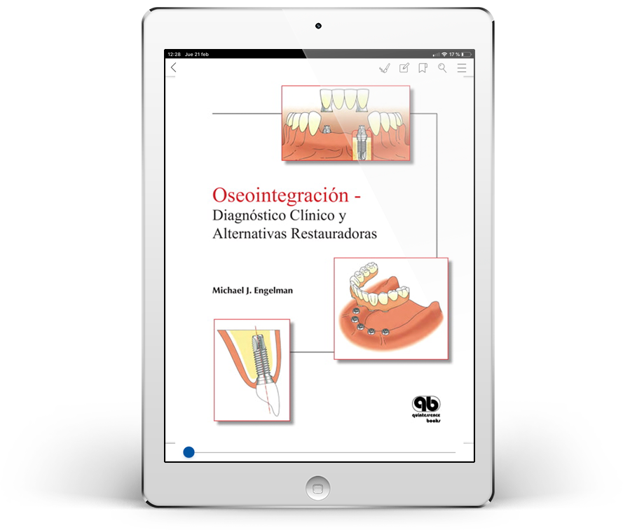 Oseointegración: Diagnóstico Clínico y Alternativas Restauradoras
