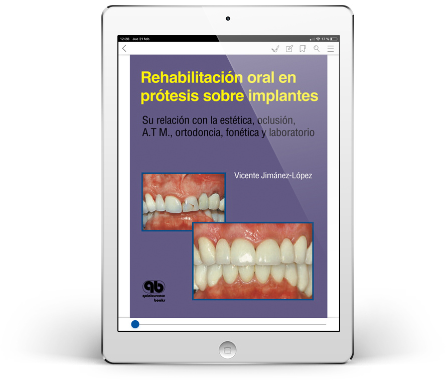 Rehabilitación oral en prótesis sobre implantes: Su relación con la Estética, Oclusión, A.T.M., Ortodoncia, Fonética y Laboratorio