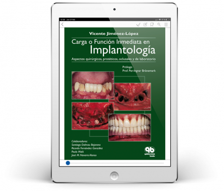 Carga o Función Inmediata en Implantología