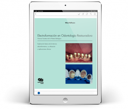 Electroformación en Odontología Restauradora: Nuevas Facetas de la Prótesis Biológica