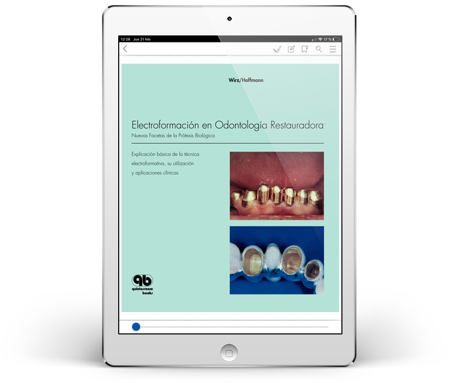 Electroformación en Odontología Restauradora: Nuevas Facetas de la Prótesis Biológica
