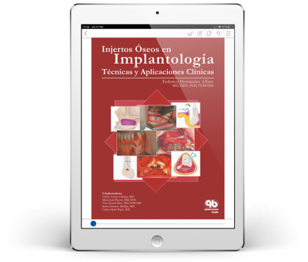 Injertos Oseos en Implantología: Técnicas y Aplicaciones Clínicas