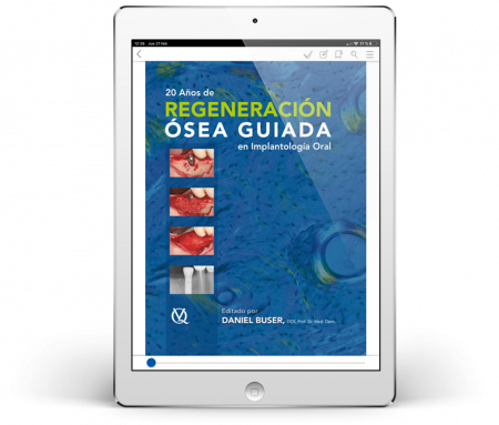 20 Años de Regeneración Ósea Guiada en Implantología (2ª Edición)