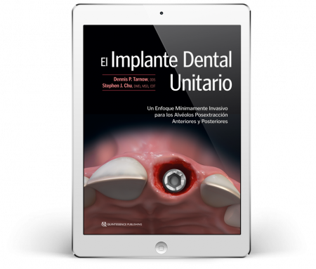 El Implante Dental Unitario